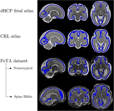 Fetal gestational age prediction via shape descriptors of cortical development